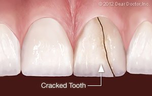 What Are Craze Lines On Teeth?