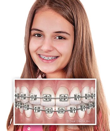 Types of Braces  General and Cosmetic Dentist in Thousand Oaks, CA