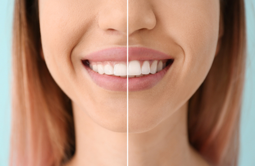 Tooth Reshaping/Contouring 