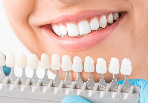 Cost Factors of Cosmetic Dentistry 