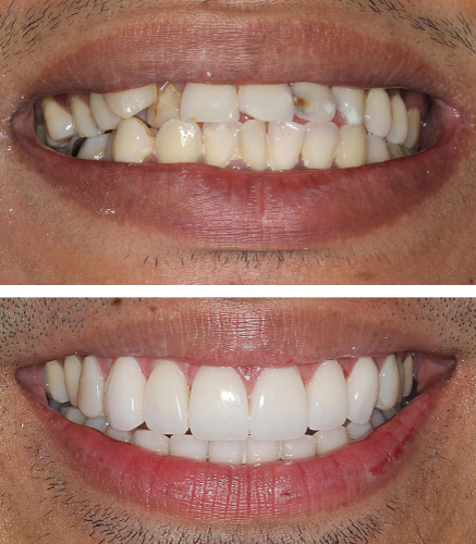 Problems Fixed by Dental Veneers