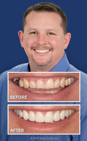 What’s In a Smile Makeover? 