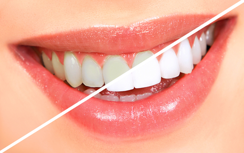 Benefits of Professional Teeth Whitening 