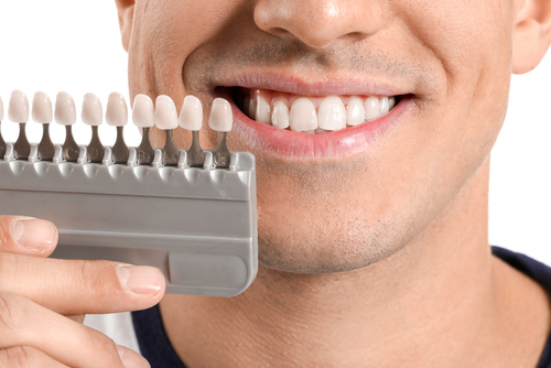 What You Need to Know About Teeth Whitening 
