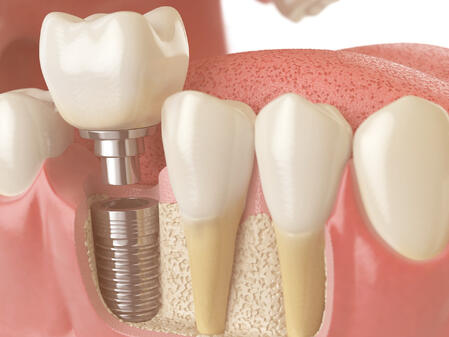 Bone Grafting